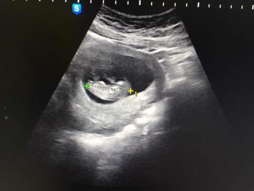 สอบถามเเม่ๆหน่อยคะกังวล