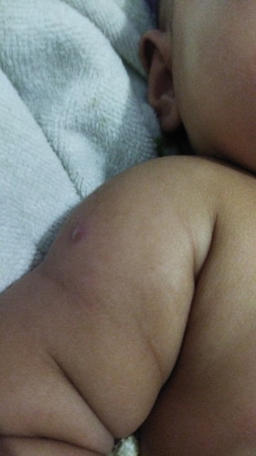 Bekas suntik imunisasi bulan pertama