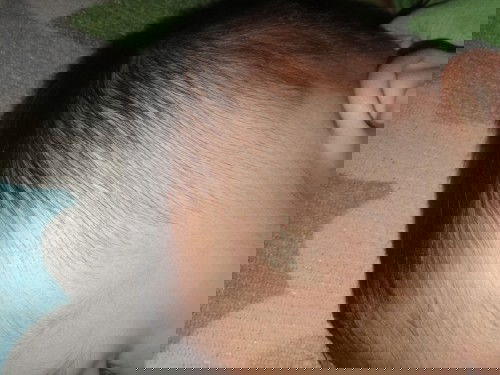 Gatal seperti benjol