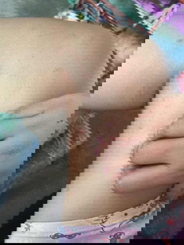 อาการคันเป็นผื่น