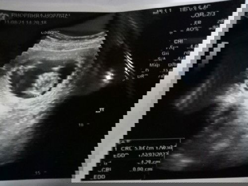 ท้องแรกดูไม่เป็น