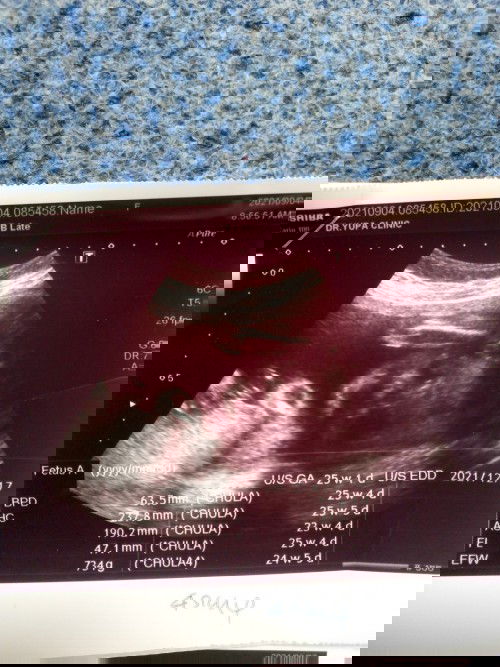 วันนี้ไปอัลตร้าซาวด์ คุณหมอบอกน้ำหนักอยู่ในเกณฑ์ที่ดีมาก ตอนนี้ได้25w. 3 d ❤️❤️❤️❤️👼👼👼