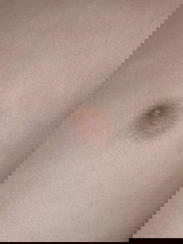 Bump in baby's nipple