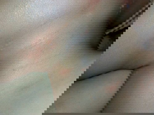 Beruntusan area leher bayi