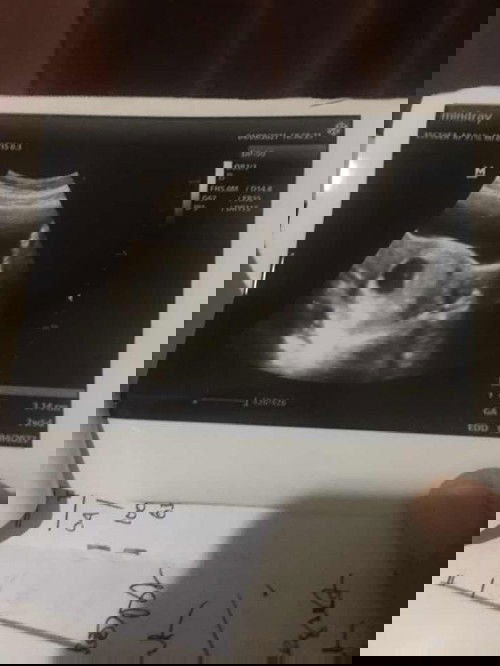 HAMIL 7 WEEKS BELUM ADA JANIN