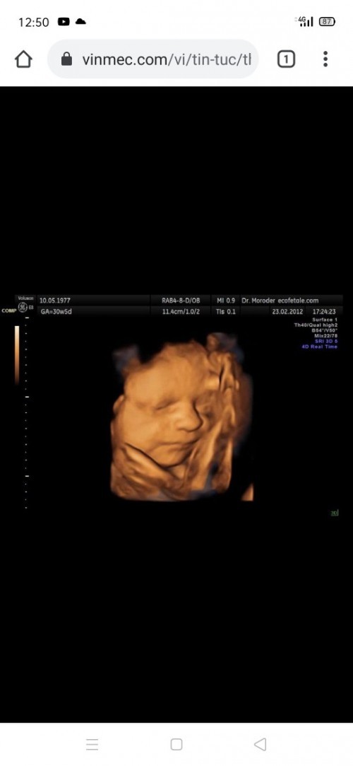 Thai 31t3n bé dc 1kg8 có ổn k ạ và có mom nào siêu âm doppler ở tuần 32 như mình k ạ