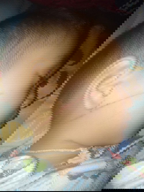 ยาป้องกันแผลเป็น