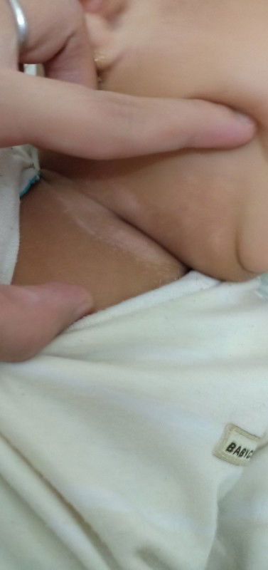 Bercak putih seperti panu