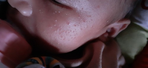 Bintik bintik pada wajah bayi
