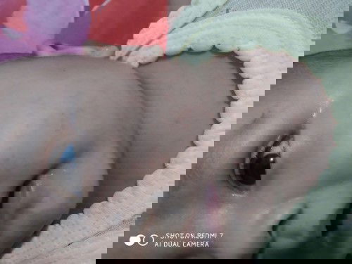 Keluar bintik² merah setelah demam