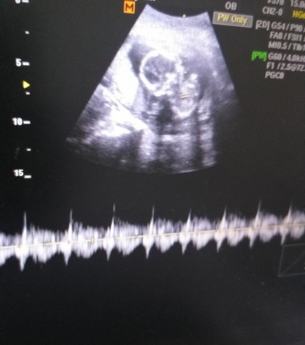 17 weeks preg. Low amniotic fluid and low din heartrate ni baby. Pa advise whats best pls. 😔