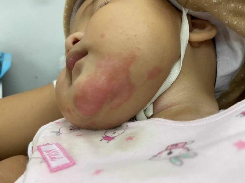 ผื่นแดงที่คอลูก