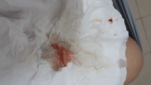 มีเลือดออก