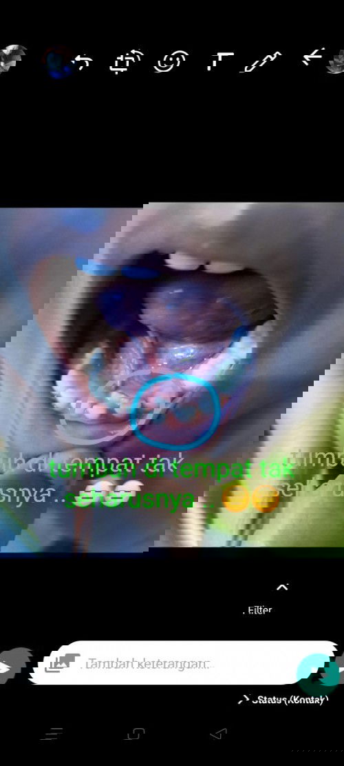 Gigi tumbuh di tempat tak semestinya ?!