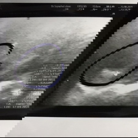 ฉีดวัคซีนโควิด(ซิโนฟาร์ม) ตอนตั้งครรภ์ไม่รู้ตัว