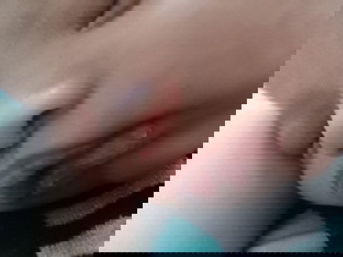 ลูกปากแห้งเพราะแพ้จุกนม หรือเพราะกินนมน้อย