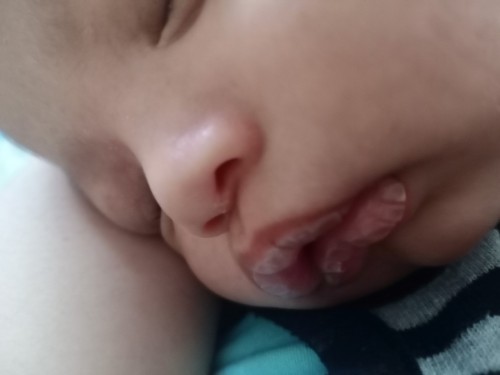 ลูกปากแห้งเพราะแพ้จุกนม หรือเพราะกินนมน้อย