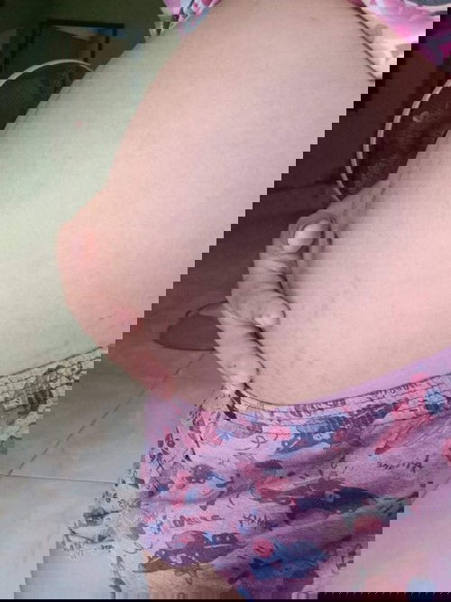 แม่บ้านไหนเป็นบ้างค่ะ ทาครีมแล้วก็ยังแตกอยู่ดี แม่บ้านนี้ทั้งทาทั่งไม่เกาเลย แตก แต่มาแตกตอน8เดือน ควรใช้ครีมตัวไหนดีค่ะ ตอนคลอดน้องแล้ว