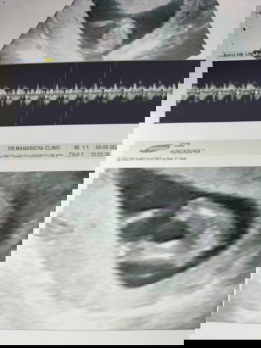 สอบถามหน่อยคะ
ซาวด์ตอน12w6d คุณหมอบอก น่าจะผู้หญิง แต่ยังไม่ฟันธง รอน้องโตอีกนิด
มีโอกาสเป็น ช. มัย