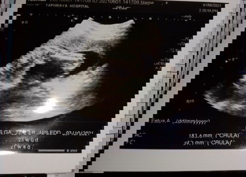 อยากทราบว่านี่คือต้นขาข้างไหนของรูป