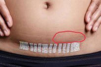 แผลผ่าคลอดบล็อกหลัง