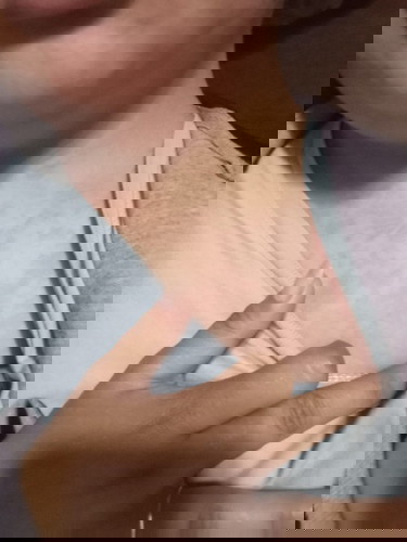 21 weeks po akong pregnant and nag katigdas po ako as in namaga po pati muka then makati din po sya