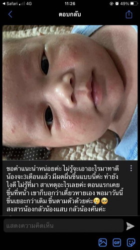 ผดผื่น ลูกน้อย
