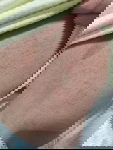 ลูกเป็นไข้และมีผื่นขึ้นตามลำตัว