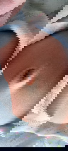 Umbilical cord hernia