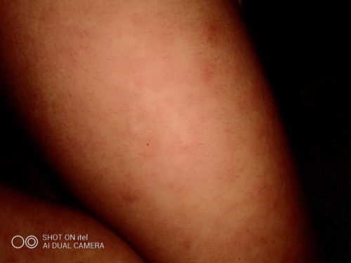 rashes 7yrs old