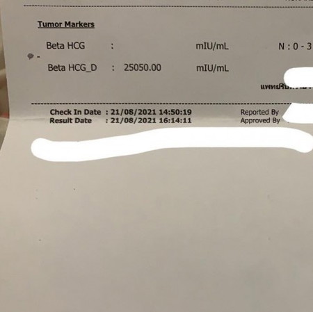ค่า hcg สูงมีโอกาสแฝดไหม