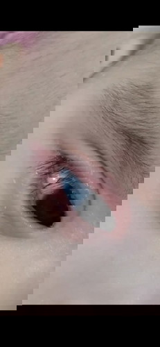 ลูกขยี้ตาจนบวมแดง