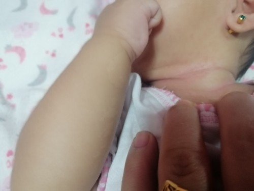 Rashes ni baby