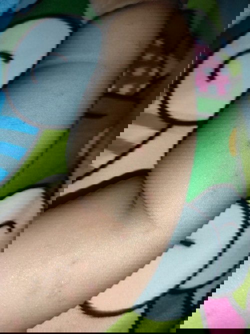 Gatal-gatal kulit bayi