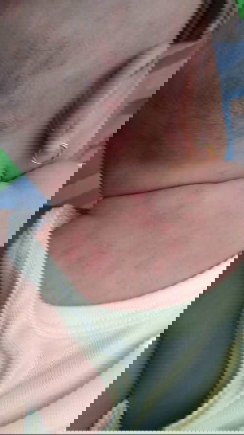 Beruntusan pada bayi