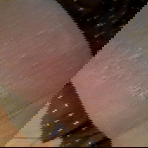 Gatal gatal pasca melahirkan