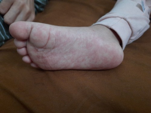 Telapak kaki anak merah merah