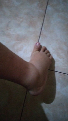 Ada yg senasib ga ya kaki ny bengkak jalan 7 bln...kira kira cara mengatasiny gmn ya?