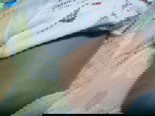 สอบถามแม่ๆหน่อยคะแบบนี้น้องเป็นเกลื้อนมั้ยค่ะ ต้องหาหมอมั้ยหรือว่าน้องหายเอง ตอนนี้ราเป็นวงกว้างแล้ว