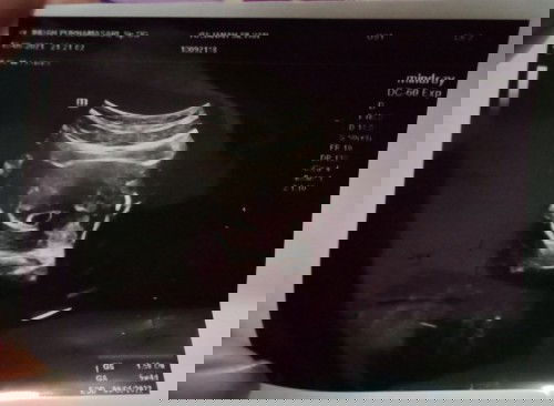 Mau tanya bunda2, kl seprti ini yg mana kantong rahimnya ya😊 soalnya td lupa nanya sma doktr.nya