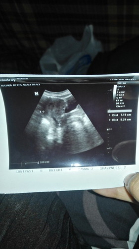 pendarahan usai hb dan hamil kosong saat usg usia kandungan 12week