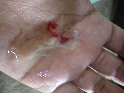 lendir bercampur darah