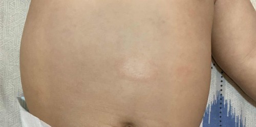Skin rashes of my 4 months old baby