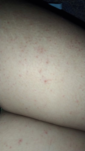 Ano po ang gamot sa RASHES?