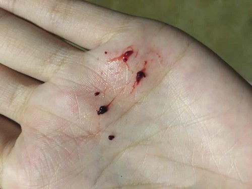 มีภาวะแท้งคุกคามค่ะ แบบนี้น้องหลุดใช่มั้ยคะ