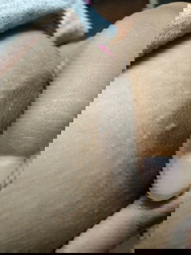 ตุ่มขึ้นแบบนี้อันตรายไหมคะ?