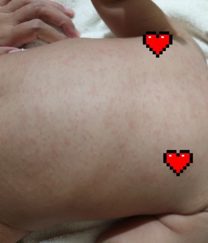 Efek setelah imunisasi campak