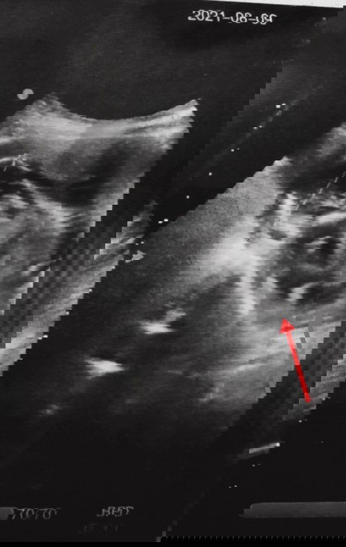 Hasil usg 15 week 6 d