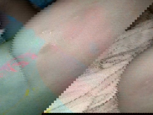 ตุ่มแบบนี้อะไรกัเหรอค่ะ