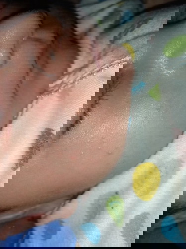 Bintik bintik merah dan berair di wajah bayi yang baru lahir